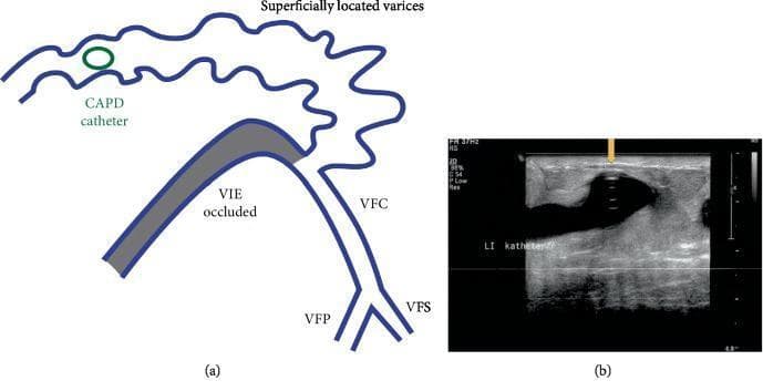 This composite educational resource consists of a schematic diagram and a corresponding diagnostic duplex ultrasound image illustrating a complication of continuous ambulatory peritoneal dialysis (CAPD) catheter placement. Figure (a) is an anatomical diagram showing venous pathology of the lower abdomen and pelvis. It depicts an occluded left external iliac vein (VIE) and a common femoral vein (VFC) branching into the profunda femoris (VFP) and superficial femoral (VFS) veins. A system of tortuous, superficially located abdominal wall varices is shown acting as collateral circulation due to the iliac occlusion. A CAPD catheter is schematically represented transfixing one of these large variceal veins. Figure (b) provides a clinical duplex ultrasound in transverse view, demonstrating a hyperechoic, circular CAPD catheter cross-section (indicated by a yellow arrow) positioned within a dilated, anechoic (dark) lumen of an abdominal wall varicose vein. The image illustrates the anatomical basis for persistent bleeding or anemia in dialysis patients when catheter placement inadvertently involves high-flow collateral venous systems developed secondary to deep venous occlusion.