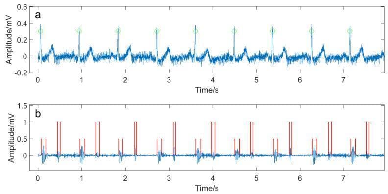 The image presents a dual-paneled physiological signal display from a patient with pulmonary hypertension, illustrating the synchronization of cardiac electrical and acoustic activity. Panel (a) shows a Lead II Electrocardiogram (ECG) trace over a 7.5-second interval. The y-axis measures amplitude in millivolts (mV), ranging from -0.2 to 0.6 mV. Green circular markers identify the detected R-waves, defining the beginning of each cardiac cycle. Panel (b) displays a corresponding heart sound signal (phonocardiogram) over the same time axis. The amplitude for the acoustic signal ranges from approximately -0.3 to 0.5 mV. Red vertical lines of varying heights indicate the detected components of the heart sound: shorter lines mark the first heart sound (S1) and longer lines mark the second heart sound (S2). This comparative visualization is used in clinical research to study the temporal relationships between electrical depolarization and mechanical valvular closure, specifically for detecting patterns or murmurs associated with pulmonary hypertension.