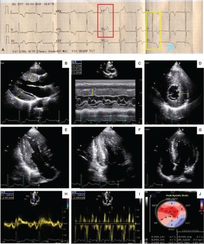 A multi-panel clinical diagnostic figure comprising a surface electrocardiogram (ECG) and transthoracic echocardiography (TTE) images related to cardiac amyloidosis evaluation. Panel A displays a 12-lead ECG showing signs of left ventricular hypertrophy (LVH), with high-amplitude QRS complexes in V2 (red box) and V5-V6 (yellow box) accompanied by a classic ST-segment depression and T-wave inversion indicative of a strain pattern (blue arrow). Panels B-G show 2D and M-mode echocardiography images illustrating significant asymmetric septal hypertrophy, with the interventricular septum measuring 2.4 cm. A distinctive 'speckled' or granular myocardial texture is visible in the short-axis views (D-E). Panels H-I utilize Tissue Doppler imaging to evaluate diastolic dysfunction, showing an E/e' ratio suggestive of grade 2 dysfunction. Panel J presents a bull's-eye map from speckle-tracking strain echocardiography, demonstrating a characteristic 'apical sparing' pattern (marked diminution of longitudinal strain in the basal and mid-segments with preserved apical function), which is highly suggestive of cardiac amyloidosis.