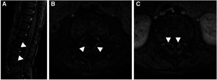 Diagnostic Images: Contrast-enhanced MRI of the lumbar spine in sagittal (A) and axial (B, C) planes demonstrating smooth enhancement of the cauda equina nerve roots. In sagittal image A, the vertebral bodies and intervertebral discs are visible, with white arrowheads indicating bright signal enhancement along the nerve roots within the spinal canal. Axial images B and C provide a cross-sectional view of the thecal sac, where white arrowheads highlight symmetrical, prominent enhancement of the anterior nerve fibers. These findings are characteristic of inflammatory or demyelinating processes affecting the peripheral nerves, such as Chronic Inflammatory Demyelinating Polyneuropathy (CIDP) or Guillain-Barré Syndrome. The imaging highlights the contrast between the enhancing nerve structures and the lower signal intensity of the surrounding cerebrospinal fluid and vertebral bone. This study serves as an educational example of neuroradiological signs of spinal nerve root pathology and the utility of post-contrast sequences in evaluating inflammatory neurological disorders.