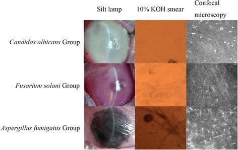 A comparative medical display illustrating fungal keratitis findings across three different pathogenic fungi: Candida albicans, Fusarium solani, and Aspergillus fumigatus. The visual content is organized in a matrix format showcasing three diagnostic modalities: slit-lamp biomicroscopy, 10% KOH smear, and confocal microscopy. Slit-lamp images demonstrate distinct corneal macroscopic variations: Candida shows a dense, white, opaque infiltrate; Fusarium presents with a reddish-pink corneal hue and a focal light reflex; and Aspergillus exhibits dark, pigmented necrotic areas with surface irregularity. The 10% KOH smears reveal microscopic fungal morphology, highlighting branching hyphae in Fusarium and spherical structures with radiating filaments in Aspergillus against an orange-stained background. Confocal microscopy panels provide high-resolution cellular views, showing bright punctate spots for Candida and dense, interconnected filamentous networks for Fusarium and Aspergillus. This resource serves as an educational guide for differentiating fungal etiologies in infectious keratitis through clinical and microbiological correlation.