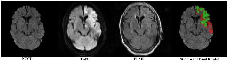 A multi-modal comparison of brain imaging from a patient with an acute ischemic stroke, featuring four axial views: Non-Contrast Computed Tomography (NCCT) with skull removal, Diffusion-Weighted Imaging (DWI), Fluid-Attenuated Inversion Recovery (FLAIR), and a labeled NCCT. The image demonstrates a clear clinicoradiological mismatch. The DWI modality reveals a distinct area of hyperintensity in the left hemisphere, signifying cytotoxic edema and the restricted diffusion characteristic of an acute infarct. In contrast, the FLAIR sequence shows minimal signal changes in the corresponding area, suggesting a 'DWI-FLAIR mismatch' indicative of hyperacute stroke within the thrombolysis window. The final panel displays the NCCT with manual segmentations: the 'Infarct Core' (IC) is highlighted in green, while the surrounding 'Infarct Penumbra' (IP) is highlighted in red. This comparison highlights the difficulty of visualizing early ischemic changes on NCCT compared to the sensitivity of MRI sequences, emphasizing the role of automated segmentation in identifying salvageable brain tissue.