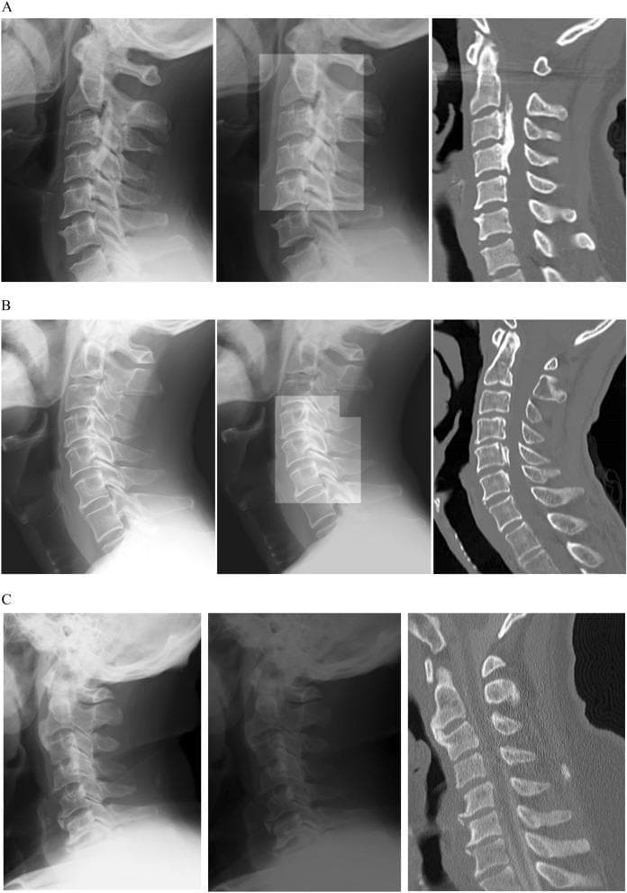A multi-panel medical comparison chart demonstrating the detection of Ossification of the Posterior Longitudinal Ligament (OPLL) in the cervical spine using deep learning. The image is organized into three rows (A, B, C) and three columns. The left column displays lateral plain radiographs of the cervical spine. The middle column shows the same radiographs with deep learning algorithm-generated heatmaps or bounding regions highlighting suspected ossification. The right column presents sagittal CT scans, serving as the clinical ground truth. Row A illustrates continuous-type OPLL, visible as a thick, linear radiopaque structure spanning C2 to C4. Row B shows segmental-type OPLL, appearing as isolated ossified patches posterior to the C5 and C6 vertebral bodies. Row C serves as a negative control, displaying a normal cervical spine with no ligamentous ossification. This comparison illustrates how algorithmic analysis can identify subtle pathological bone formations in standard X-rays, confirmed by diagnostic CT imaging, supporting orthopaedic and radiological training in spinal pathology.