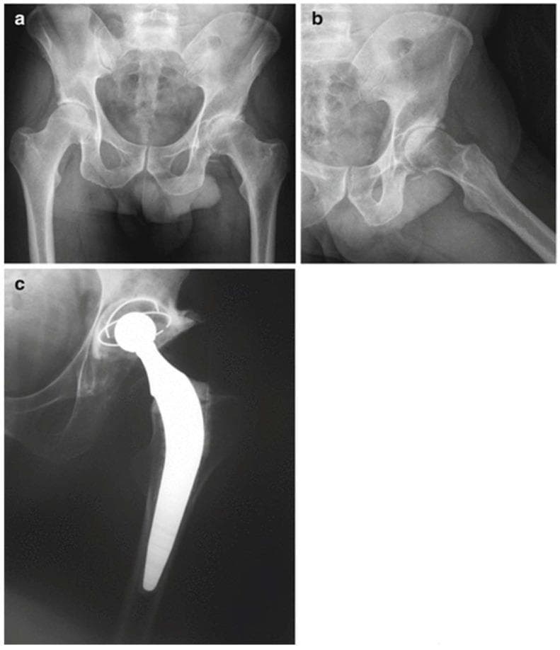 This composite of diagnostic X-ray radiographs documents a total hip replacement (THR) procedure in a patient with haemophilia. Panel (a) shows a preoperative anteroposterior view of the pelvis, revealing significant narrowing of the left hip joint space and altered morphology of the femoral head consistent with advanced haemophilic arthropathy or secondary osteoarthritis. Panel (b) provides a lateral preoperative view focusing on the left hip, highlighting the degenerative changes and bony remodeling. Panel (c) is a postoperative radiograph demonstrating the successful implantation of a total hip prosthesis. The image displays a highly radio-opaque metallic femoral stem anchored within the femoral canal, a spherical femoral head component, and an acetabular cup with visible marker wires. The alignment of the prosthetic components restores the joint space and structural integrity of the hip. This educational series illustrates the transition from severe joint pathology to surgical reconstruction in the context of specialized orthopedic management for bleeding disorders.