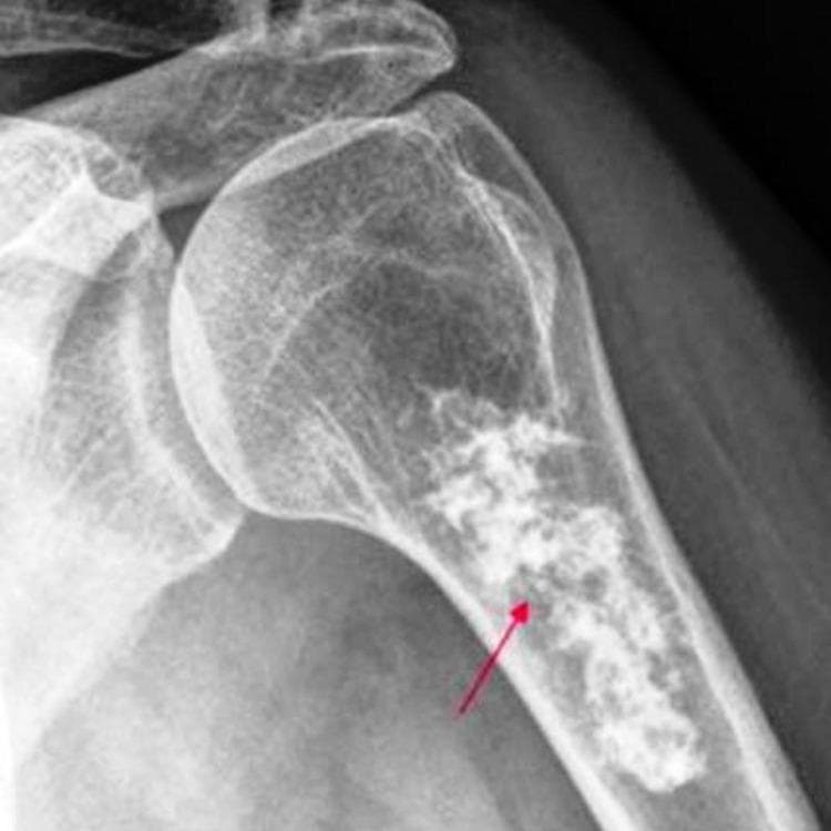 Anteroposterior X-ray of the proximal humerus showing an aggressive, intramedullary osteolytic lesion. The lesion is primarily located within the metaphysis and extends into the proximal diaphysis. It exhibits a mottled, permeative appearance with poorly defined, irregular borders, indicating a narrow zone of transition. There is evidence of cortical thinning and a 'moth-eaten' pattern of bone destruction, characteristic of malignant processes such as Ewing sarcoma. A red arrow highlights the area of most significant radiolucency and architectural disruption within the medullary canal. The image demonstrates key radiological signs used in orthopedic oncology to differentiate aggressive primary bone tumors from benign lesions.