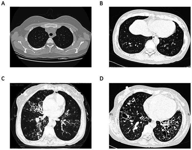 This diagnostic image composite features four High-Resolution Computed Tomography (HRCT) axial slices of the chest, illustrating a grading system for the severity of bronchiectasis. Panel A demonstrates normal lung parenchyma and bronchial anatomy (Score 0). Panel B illustrates mild bronchiectasis (Score 1) involving a single bronchopulmonary segment, characterized by slight airway dilation. Panel C shows moderate bronchiectasis (Score 2) with more than one segment involved in a lobe, exhibiting prominent bronchial wall thickening and the 'signet ring sign.' Panel D displays severe, cystic bronchiectasis (Score 3), characterized by gross cystic dilation of the airways and significant destruction of the lung architecture. The image serves as an educational tool for pulmonology and radiology, demonstrating the progression from healthy tissue to severe airway remodeling and the categorical assessment of bronchiectatic extent across different pulmonary segments and lobes.