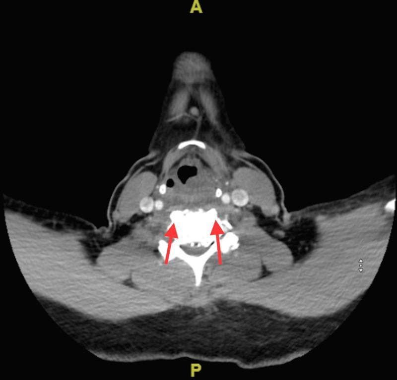 This axial computerized tomography (CT) scan of the cervical spine demonstrates a characteristic radiological finding of calcific tendonitis of the longus colli muscle. Centrally, a cervical vertebral body is visible with normal cortical density. Two red arrows point to amorphous, high-attenuation (hyperdense) calcifications located in the prevertebral soft tissue, specifically within the superior fibers of the longus colli muscle at the C1-C2 level. There is associated thickening of the prevertebral soft tissues, which can indicate edema or fluid accumulation. The surrounding anatomy includes the pharyngeal space and soft tissues of the neck. This diagnostic image is essential for differentiating this benign, self-limiting inflammatory condition from more serious pathologies like retropharyngeal abscess or spondylodiscitis. The content is suitable for medical education in radiology, emergency medicine, and orthopedics.