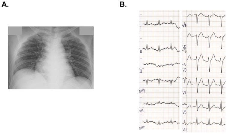 This composite clinical diagnostic image includes a chest X-ray (A) and a 12-lead electrocardiogram (B). Panel A shows a posterior-anterior (PA) view of the thorax, demonstrating a markedly enlarged cardiac silhouette consistent with cardiomegaly. The lung fields exhibit increased bronchovascular markings and subtle bilateral interstitial opacities, characteristic of mild pulmonary congestion. Panel B displays a 12-lead ECG strip showing a regular sinus rhythm. Notably, there is an absence of ST-segment elevation or significant ischemic changes across the limb leads (I, II, III, aVR, aVL, aVF) and precordial leads (V1-V6), which clinically helps rule out acute ST-elevation myocardial infarction (STEMI) in the context of acute heart failure. The primary educational focus is the correlation between radiological findings of biventricular enlargement/congestive heart failure and the corresponding baseline electrical activity of the heart.