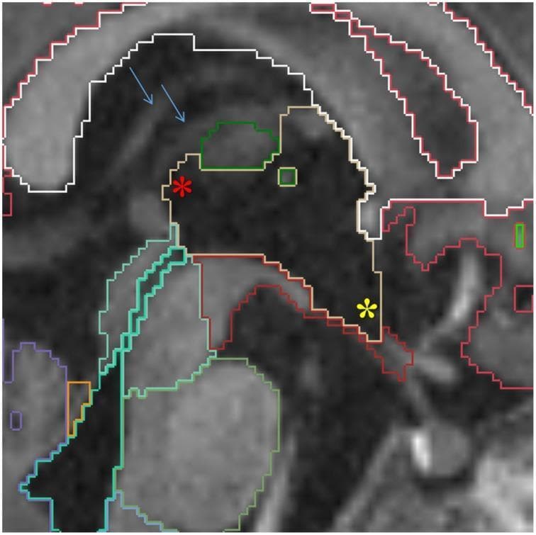 This diagnostic image is a T1-weighted sagittal MRI of an infant's brain, focusing on the neuroanatomical segmentation of the midline structures. The third ventricle is centrally featured and outlined in yellow, showing key anatomical landmarks: the suprapineal recess (indicated by a red star) and the infundibular recess (indicated by a yellow star). Blue arrows point to the internal cerebral veins situated within the transverse fissure, which serves as the posterior boundary for third ventricle segmentation. Various color-coded outlines delineate surrounding regions: white matter (white), cerebral cortex (red), ventral diencephalon (VDC, dark red), mesencephalon (turquoise), pons (green), and medulla (baby blue). The fourth ventricle and cerebral aqueduct are highlighted in lime green, while the cerebellar vermis is outlined in violet. This image serves as a detailed educational tool for manual segmentation protocols in pediatric neuroimaging, emphasizing the spatial relationships between ventricular recesses and deep vascular landmarks.