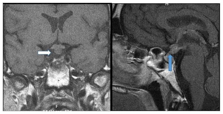 This diagnostic imaging composite displays two T1-weighted magnetic resonance imaging (MRI) scans of the brain focusing on the sellar and suprasellar regions. Image A is a coronal view highlighting a diffuse, bulbous thickening of the pituitary infundibulum (indicated by a white arrow), which appears isointense to slightly hyperintense compared to the surrounding brain parenchyma. Image B is a sagittal view demonstrating the absence of the normal physiological 'posterior pituitary bright spot' (indicated by a blue arrow) within the sella turcica. These radiographic findings are characteristic of pituitary stalk lesions and are clinically significant in the diagnostic evaluation of central diabetes insipidus and intracranial germinomas. The visual data is optimized for teaching medical professionals about neuroendocrine anatomy, infundibular pathology, and the interpretation of gadolinium-enhanced or T1-weighted neuroradiological features.