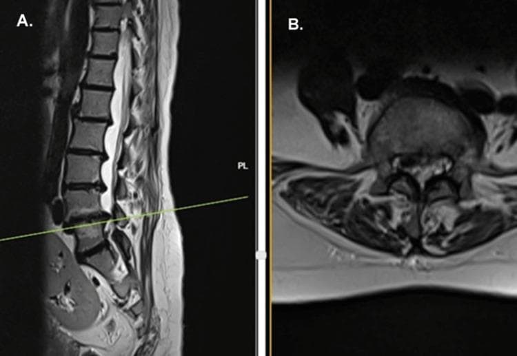 This diagnostic image consists of two MRI views of the lumbar spine: a sagittal section (A) and an axial section (B) at the L4-L5 level. In the sagittal view, the lumbar spine demonstrates preserved lordotic curvature, but multiple intervertebral discs exhibit signal hypointensity on T2-weighted imaging, consistent with widespread disc dehydration and degeneration. Notably, at the L4-L5 level, there is a significant posterior disc prolapse that is hypointense, suggesting potential calcification or dense fibrosis. The axial view (B) reveals a central and right paracentral disc herniation encroaching upon the spinal canal and the right lateral recess. This herniated material is causing visible mass effect and impingement on the neural structures, specifically the thecal sac and the right-sided nerve roots. These findings are characteristic of degenerative disc disease and may be associated with systemic metabolic conditions like alkaptonuria/ochronosis when presenting with such extensive disc calcification. The imaging serves as a clinical education tool for identifying lumbar disc herniation, spinal stenosis, and secondary neural impingement.