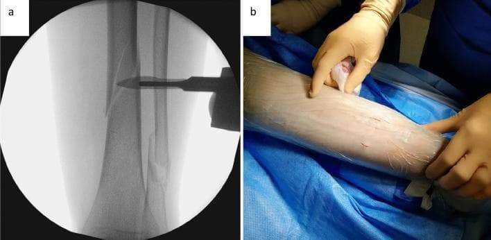This composite educational image demonstrates the initial steps of a minimally invasive cerclage wiring technique for a tibial spiral fracture. Panel A is an intraoperative fluoroscopic (X-ray) image using an image intensifier. It shows a mid-shaft spiral fracture of the tibia (AO 42A1c) that has undergone anatomical reduction. A radiopaque surgical instrument with a tapered shaft and paddle-like tip is positioned perpendicularly to the tibial shaft to identify the target level for cerclage placement. Panel B is a clinical photograph showing the surgical field preparation of the lower leg. The limb is covered with a transparent sterile adhesive drape. Two small, approximately 1 cm longitudinal incisions are visible: one on the anterolateral aspect and one on the dorsomedial aspect of the tibia. A surgeon’s gloved hand is shown palpating the proximal incision site. The image illustrates the transition from radiological planning to the execution of minimally invasive portals in orthopedic trauma surgery.