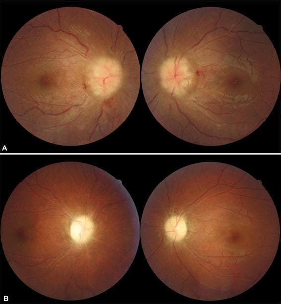 This comparative fundus photograph series demonstrates the progression and resolution of severe bilateral papilledema in a patient with pseudotumor cerebri syndrome. Top row (A): Initial presentation showing grade 5 papilledema in both eyes. The optic discs are severely swollen, elevated, and have blurred margins. Key clinical signs include peripapillary hemorrhages and significant obscuration of the major retinal vessels as they leave the disc. The nerve fiber layer appears thickened and opacified. Bottom row (B): Post-treatment follow-up after 6 months. The acute optic disc edema has completely resolved, but clinical sequelae are visible. The optic discs now exhibit a pale, chalky appearance characteristic of optic atrophy. There is noticeable narrowing (attenuation) of the retinal arterioles and a reduction in the previous vascular engorgement. The image highlights the critical transition from acute hypertensive disc swelling to chronic secondary optic atrophy, emphasizing the importance of monitoring vascular changes and disc pallor in neuro-ophthalmological conditions.