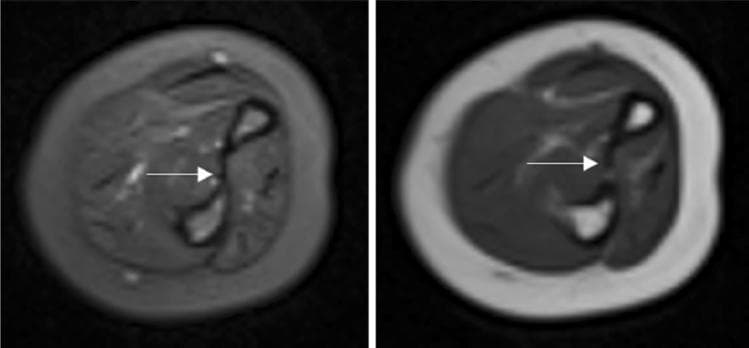This diagnostic image displays side-by-side axial MRI scans of the human forearm, featuring a T2-weighted sequence (left) and a T1-weighted sequence (right). The cross-sectional anatomy clearly depicts the radius and ulna bones, surrounded by muscle compartments and a thick layer of subcutaneous fat. In the T1-weighted image, the bone marrow and subcutaneous fat exhibit a high (bright) signal, while the muscles appear with intermediate signal intensity. In the T2-weighted image, the fat remains bright, but fluid and certain soft tissue details show increased contrast. A white arrow in both images points specifically to the interosseous membrane, which appears as a thin, continuous, low-signal (dark) band spanning the space between the radius and ulna. The membrane shows no signs of tearing, thickening, or edema, indicating no acute injury. This comparison is used in clinical education to demonstrate normal musculoskeletal ligamentous structures and the signal characteristics of different forearm tissues in the context of orthopedic evaluation for conditions like Monteggia fractures.