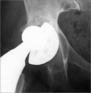 Anteroposterior (AP) radiograph of the hip demonstrating a failed total hip arthroplasty (THA). The primary finding is a completely loosened and displaced acetabular cup. The metallic hemispheric shell shows a significant loss of fixation, characterized by its inferior and lateral migration from the anatomical acetabular roof. A wide, continuous radiolucent zone is visible at the bone-implant interface, indicating a complete lack of osseointegration and separation from the surrounding pelvic bone. The cup also exhibits a significant change in inclination (tilting) compared to standard physiological alignment. The femoral component, including the prosthetic head and neck, remains articulated within the cup, but the entire assembly is malaligned. This image serves as a clinical example of aseptic loosening and prosthetic migration, highlighting key diagnostic signs for orthopedic evaluation of implant failure and the need for revision surgery.