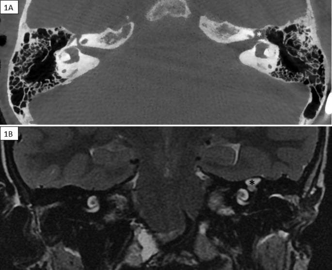 This diagnostic image set consists of two panels comparing the left temporal bone in axial Cone Beam CT (1A) and coronal T2-weighted MRI (1B). The primary finding is fluid ectasia localized at the left geniculate ganglion, marked with an asterisk (*). In the Cone Beam CT, the area appears as a focal, well-defined region of low density (hypodense) compared to the adjacent dense petrous bone. In the T2-weighted MRI, the same region demonstrates high signal intensity (hyperintense), characteristic of cerebrospinal fluid or fluid collection. This fluid ectasia is shown in continuity with the labyrinthine and tympanic segments of the facial nerve canal. Despite the expansion, the CT imaging shows that the surrounding bony walls remain intact, with no evidence of dehiscence or communication with the ipsilateral middle cranial fossa. Anatomical landmarks such as the mastoid air cells, cochlea, and semicircular canals are visible. The comparison highlights the utility of multimodality imaging in assessing facial nerve pathology and associated fluid leaks within the temporal bone.