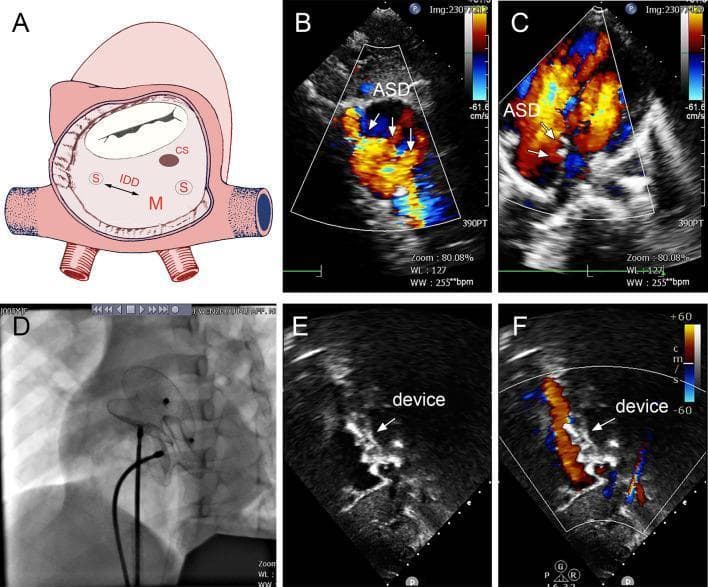 This composite figure illustrates the diagnosis and transcatheter management of multiple atrial septal defects (ASDs). (A) Anatomical diagram showing the interatrial septum with multiple defects: a moderate defect (M) and two small defects (S) labeled with interdefect distance (IDD). (B, C) Transthoracic echocardiography (TTE) with Color Doppler in different planes demonstrating bidirectional, mosaic-colored shunting (red and blue) through the atrial septal defects, confirming turbulent flow. (D) Fluoroscopic radiographic image showing the deployment of two catheter-based occluder devices (MemoPart ASDO) positioned within the heart. (E) Post-operative grayscale TTE showing the echogenic occluder devices securely positioned across the septum. (F) Post-operative Color Doppler echocardiography demonstrating the absence of residual shunting across the atrial septum, indicating successful procedural closure of the multiple defects. This content is designed for cardiology and pediatric educational purposes, highlighting the use of multiple occluders for complex septal anatomy.