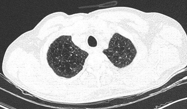 This diagnostic image is an axial non-contrast high-resolution computed tomography (HRCT) scan of the thorax at the level of the upper lobes. The image demonstrates bilateral, diffuse, and homogeneous areas of abnormally decreased lung attenuation (hyperlucency). These findings are characteristic of panacinar (panlobular) emphysema, where there is a uniform destruction of the pulmonary acinus. Key features include a simplified lung architecture with a notable paucity of pulmonary vascular markings throughout the affected parenchyma. Unlike centriacinar emphysema, which often shows focal areas of low attenuation, this presentation shows a generalized darkening of the lung fields without well-defined walls or cystic structures. No acute infiltrates, ground-glass opacities, or consolidations are present, which in a clinical context (such as COVID-19 screening) helps differentiate chronic obstructive pulmonary disease (COPD) from acute infectious processes. The image serves as a classic educational example of end-stage alveolar destruction and hyperinflation seen in severe emphysema.