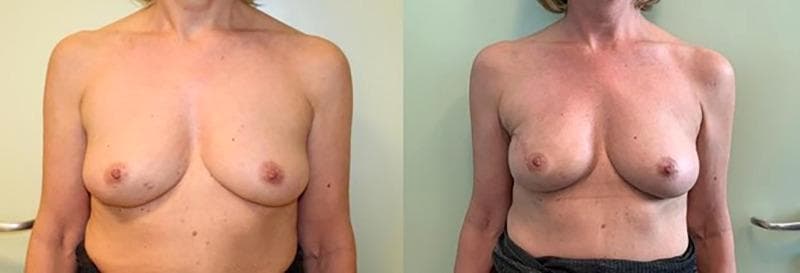 Clinical photograph comparison of a female patient's upper torso showing pre-operative (left) and post-operative (right) results of immediate breast reconstruction (IBR). The pre-operative view demonstrates natural breast anatomy with moderate ptosis and inferiorly oriented nipple-areola complexes. The post-operative view showcases the outcome of a monolateral nipple-sparing mastectomy followed by retromuscular prosthetic implantation. Notable changes include increased projection, improved breast volume and upper pole fullness, and a more anterior/superior orientation of the nipple-areola complexes. The images demonstrate the surgical objective of maintaining skin envelope integrity and nipple-areola preservation while restoring breast symmetry and contour. This clinical comparison is relevant for plastic and reconstructive surgery education, specifically illustrating standard retromuscular techniques in oncological breast surgery.