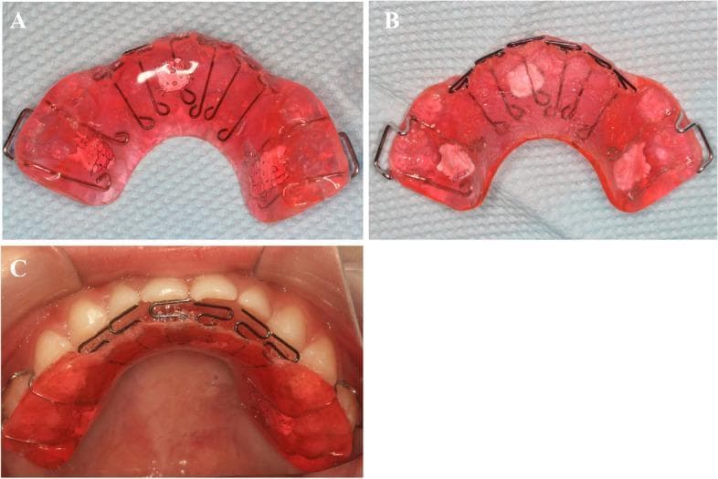 This composite clinical and intraoral image illustrates a maxillary pad movable appliance used in pediatric orthodontics for treating skeletal Class III malocclusion in the deciduous dentition. Panels (A) and (B) show the front and back views of the appliance, respectively. It features a horseshoe-shaped, reddish-pink acrylic base with integrated stainless steel wire components, including Adam’s clasps for molar retention and multiple hyperbolic tongue springs designed to apply labial pressure to the anterior teeth. Panel (B) reveals opaque white occlusal pads embedded in the acrylic, which function to relieve the crossbite and guide mandibular repositioning. Panel (C) is an intraoral photograph showing the appliance in situ. The acrylic base conforms to the palatal vault, while the wire springs are positioned against the lingual surfaces of the maxillary incisors. The appliance serves as a functional tool to correct dental retroversion and facilitate mandibular retreat, reconstructing a normal occlusal relationship prior to the eruption of permanent dentition.
