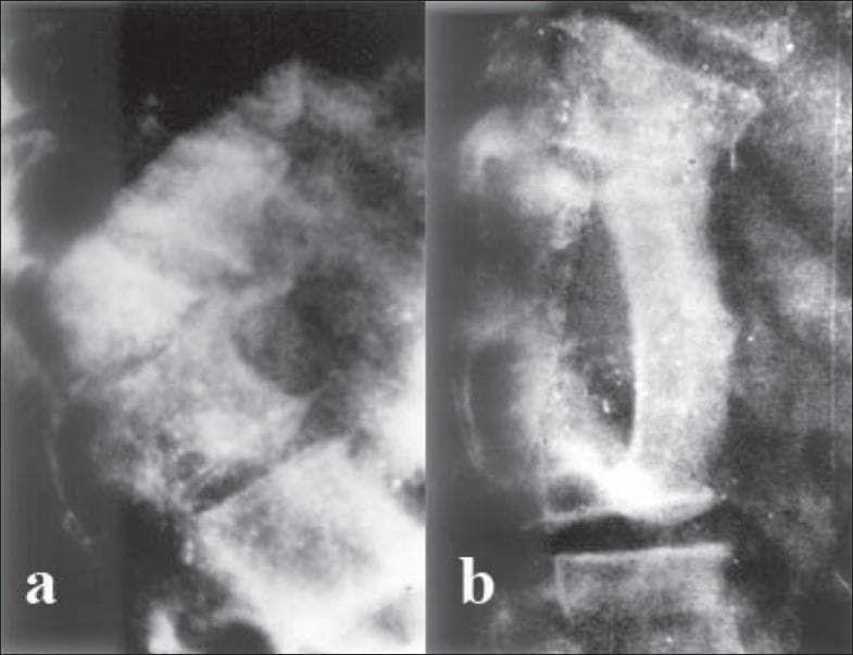 This lateral-view spinal skiagram (X-ray) comparison demonstrates the preoperative and postoperative states of a severe thoracolumbar kyphotic deformity. (a) Preoperative image: Shows a high-grade, acute angular kyphosis of the dorsal spine. A wedge-shaped 'internal gibbus' is visible, formed by the anterior collapse and subsequent posterior protrusion of vertebral remnants into the spinal canal, leading to mechanical spinal stenosis. (b) Postoperative image: Displays the result of anterior decompression via gibbus excision. The sharp curvature is noticeably corrected, and an autogenous iliac bone graft is seen bridging the intervertebral gap to provide structural stability and promote arthrodesis. The alignment of the vertebral column is significantly improved compared to the preoperative state. The images illustrate surgical management for paraplegia resulting from healed spinal tuberculosis (Pott's disease) with secondary kyphosis.