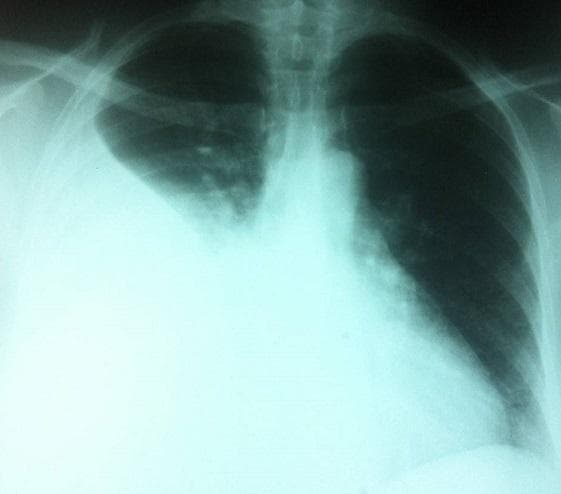 This diagnostic image is a posterior-anterior (PA) chest radiograph demonstrating a large, dense, homogenous opacity in the right hemithorax. The opacity occupies approximately the lower two-thirds of the right lung field, obscuring the right hemidiaphragm and heart border (positive silhouette sign). The superior margin of the opacity exhibits a concave, meniscus-like contour rising laterally, which is a classic radiological sign of a large pleural effusion. The left lung field remains relatively clear with visible bronchovascular markings. The mediastinal shadow, including the trachea and cardiac silhouette, appears largely midline, though there is subtle contralateral displacement due to the volume of the effusion. The skeletal structures, including the ribs and clavicles, are intact. This finding is clinically significant for diagnosing pleural fluid accumulation, which in the context of an adnexal mass and ascites, may suggest Meigs syndrome or metastatic ovarian cancer.