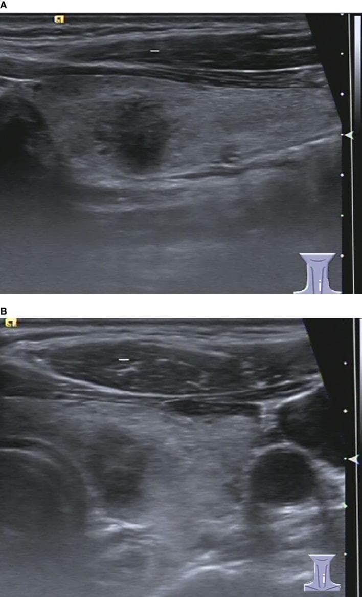 This diagnostic image displays two B-mode ultrasound scans (longitudinal view in A, axial view in B) of a human thyroid gland, demonstrating a focal nodule in the left lobe. The visual content showcases a solid, markedly hypoechoic nodule relative to the surrounding hyperechoic thyroid parenchyma. Key morphological features include an irregular shape and ill-defined margins. In the longitudinal scan (A), the nodule exhibits a 'taller-than-wide' orientation (anteroposterior diameter greater than the transverse diameter), which is a significant ultrasound finding in thyroid risk stratification. No posterior acoustic enhancement or shadowing is clearly evident. The surrounding thyroid tissue displays a heterogeneous echotexture, consistent with the patient's background of chronic lymphocytic thyroiditis. In the axial scan (B), the relationship of the thyroid lobe to adjacent cervical vascular structures is visible. This image serves as an educational example of TIRADS-based risk assessment (C-TIRADS 4C/K-TIRADS 5/ACR-TIRADS 5) for thyroid malignancies, despite the histopathological diagnosis of benign lymphocytic thyroiditis.