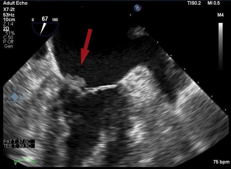 Diagnostic ultrasound image, specifically a transesophageal echocardiogram (TEE) in a mid-esophageal view, focusing on the mitral valve apparatus. A red arrow identifies a distinct, irregular, and heterogeneously echogenic mass attached to the atrial surface of the anterior mitral valve leaflet. This mobile density is characteristic of a vegetation. The imaging demonstrates the vegetation protruding towards the left ventricular outflow tract (LVOT). Clinical context suggests this finding is consistent with non-bacterial thrombotic endocarditis (marantic endocarditis), particularly given the underlying malignancy noted in the patient's history. This visual is intended for medical education regarding the sonographic identification of valvular vegetations, the differentiation between infective and non-infective endocarditis, and the evaluation of embolic risk in cardiac patients.