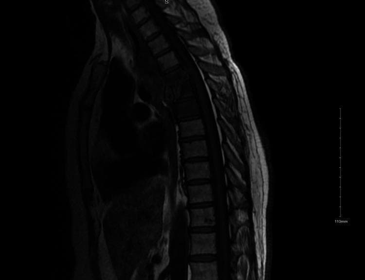 This diagnostic image is a T1-weighted sagittal MRI of the thoracic spine demonstrating classic radiological features of tuberculous spondylitis (Pott disease). The image shows significant pathology concentrated at the T4, T5, and T6 levels, characterized by altered marrow signal intensity within the vertebral bodies. There is evidence of endplate destruction and narrowing of the T4-T5 intervertebral disc space, indicating discitis-osteomyelitis. A large, multiloculated prevertebral and paraspinal soft tissue mass is visible, representing a tuberculous 'cold abscess' in the posterior mediastinum. This collection appears to exert a mass effect on adjacent anterior structures, such as the esophagus. The spinal canal shows potential for impingement due to the localized inflammation and bony destruction. This image serves as a key educational example of extrapulmonary tuberculosis presenting as spinal infection with associated paraspinal abscess formation.