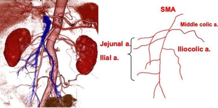 This visual contains a pair of images depicting abdominal vascular anatomy via three-dimensional computed tomography (3D-CT) angiography and a corresponding schematic line diagram. The 3D reconstruction shows the abdominal aorta in red and the inferior vena cava in blue, situated between the kidneys. The primary focus is the superior mesenteric artery (SMA) and its branching pattern. In this specific clinical case, the jejunal and ileal arteries are shown originating from the right side of the SMA, while the ileocolic and middle colic arteries branch from the left side. This inverted vascular orientation relative to the SMA is a key diagnostic indicator of intestinal malrotation (non-rotation type). The schematic on the right provides clear labels for the SMA and its primary branches to illustrate this atypical spatial relationship. The content serves as an educational resource for surgical gastroenterology and radiology in identifying anatomical variations of the mesenteric vasculature.