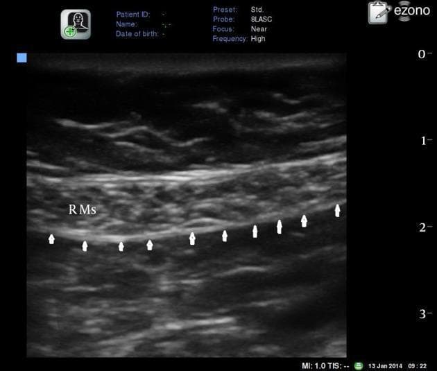 A transverse grayscale diagnostic ultrasound image of the anterior abdominal wall, specifically focusing on the rectus abdominis muscle (RMs) for clinical anatomy or procedural guidance. The imaging modality utilizes a high-frequency linear array probe with a 'near' focus, set to a depth of approximately 3-4 cm. The rectus abdominis muscle appears as a relatively hypoechoic, spindle-shaped structure with internal striated echotexture characteristic of skeletal muscle. Directly deep to the RMs, a distinct, continuous hyperechoic (bright white) horizontal line is identified by several small white arrows, representing the posterior rectus sheath. This anatomical landmark is crucial for identifying the plane for a Rectus Sheath Block (RSB). The image provides clear visualization of the relationship between the muscle belly and the underlying fascial plane, which is essential for regional anesthesia and pain management in surgical procedures involving the midline or umbilical region.