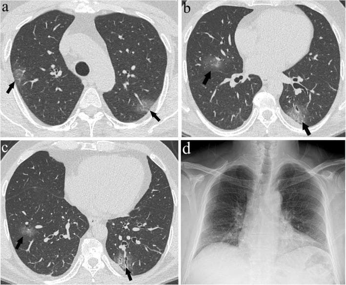 This composite medical image presents a comparison between high-resolution axial CT scans and a posteroanterior chest X-ray (CXR) from a 56-year-old male with COVID-19 pneumonia. Panels (a), (b), and (c) display axial CT slices at the levels of the upper, middle, and lower lung zones, respectively. These images reveal multifocal, bilateral ground-glass opacities (GGOs) indicated by black arrows. The GGOs appear as hazy, increased attenuation of the lung parenchyma without obscuring the underlying vascular structures, characteristic of grade 1 lesions. The distribution is notably peripheral and involves all three lung zones, yielding a total CT Score (CTS) of 6. In contrast, panel (d) shows the corresponding CXR, which appears largely unremarkable with clear lung fields and no discernible signs of pneumonia or hazy opacities. This comparison highlights the superior sensitivity of CT over CXR in detecting early or mild manifestations of viral pneumonia, such as small areas of ground-glass opacity that do not significantly alter the overall radiographic density on conventional X-ray.