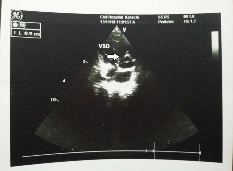 Diagnostic ultrasound: A black-and-white transthoracic echocardiogram in a pediatric patient. The image displays a cross-sectional view of the cardiac chambers and septa. A prominent white arrow points to a clear anatomical discontinuity in the ventricular septum, labeled 'VSD', which identifies a Ventricular Septal Defect measuring approximately 0.9 cm based on the on-screen caliper scale. The imaging demonstrates the structural interruption between the right and left ventricles. Metadata headers indicate the procedure was performed with a pediatric probe (65RS) at a mechanical index (MI) of 1.0. This visual serves to illustrate a core component of congenital heart disease, specifically associated with Tetralogy of Fallot in the clinical context of congenital CMV infection. The ultrasound highlights the use of echocardiography in identifying intracardiac shunts and septal abnormalities in neonatal and pediatric populations.