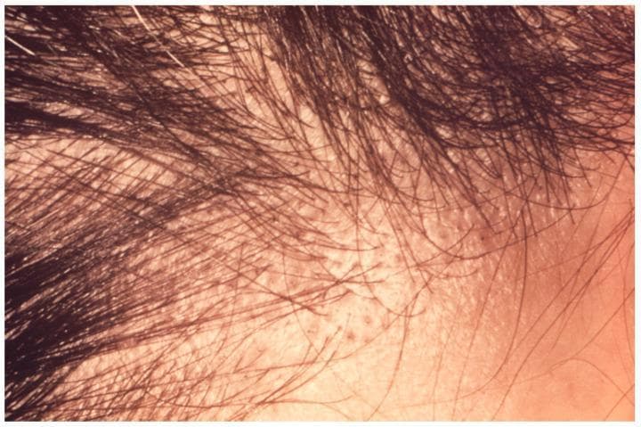 This clinical photograph shows the scalp of an adult male exhibiting signs of non-inflammatory tinea capitis, specifically a 'black dot' alopecia pattern typical of Trichophyton violaceum infection. The image demonstrates a localized area of significant hair thinning and patchy alopecia. High-resolution detail reveals numerous broken hair shafts that have fractured at the level of the scalp surface, appearing as small, dark, comedo-like plugs or 'black dots.' The underlying skin shows mild, diffuse fine scaling without evidence of severe inflammation, kerion formation, or scarring. The hair distribution is uneven, with short, brittle shafts interspersed between areas of complete hair loss. This visual illustrates the endothrix invasion pattern where fungal spores weaken the hair shaft internally, leading to easy breakage. Educational focus is on the diagnostic identification of dermatophytosis of the scalp in an adult and the differentiation between various alopecia morphologies.