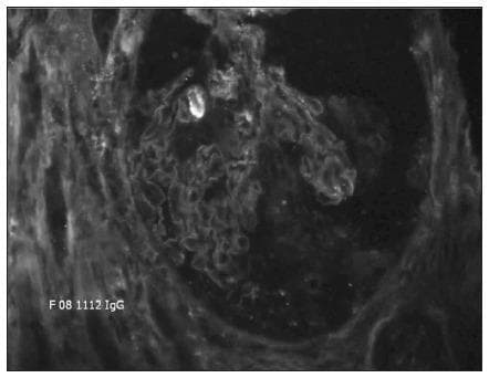 This diagnostic image shows a direct immunofluorescence (DIF) microscopy of a percutaneous kidney biopsy specimen at 20X magnification. The image demonstrates a hallmark pathognomonic finding: strong, continuous, linear immunofluorescence staining along the glomerular basement membrane (GBM). The staining outlines the capillary loops of the glomerulus with high intensity and uniformity, indicating the deposition of immunoglobulin G (IgG) antibodies directly against the basement membrane. The surrounding mesangial regions and Bowman's space show significantly less fluorescence, creating a sharp contrast that emphasizes the linear pattern. This visual presentation is characteristic of anti-glomerular basement membrane (anti-GBM) antibody disease, often associated with Goodpasture syndrome or rapidly progressive (crescentic) glomerulonephritis. The clinical significance of this finding is the confirmation of autoimmune-mediated renal damage where autoantibodies target Type IV collagen within the GBM.