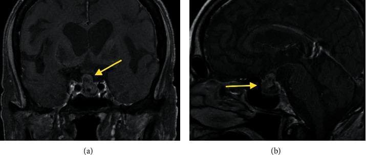 This diagnostic image provides a comparison of (a) coronal and (b) sagittal views of a brain MRI, demonstrating a 2 cm pituitary adenoma. The lesion is identified by yellow arrows in both views. In the coronal section, the mass is centrally located within the sella turcica, exhibiting a rounded morphology with signal intensity largely isointense to brain parenchyma. In the sagittal section, the relationship between the adenoma and the skull base is visible, showing the mass arising from the sellar region and extending superiorly toward the suprasellar cistern. This image illustrates key neuroanatomical landmarks, including the pituitary gland, the sella turcica, and the relative proximity to the optic chiasm and hypothalamus. It serves as an educational resource for identifying sellar masses and understanding the radiological presentation of a pituitary adenoma in different anatomical planes.