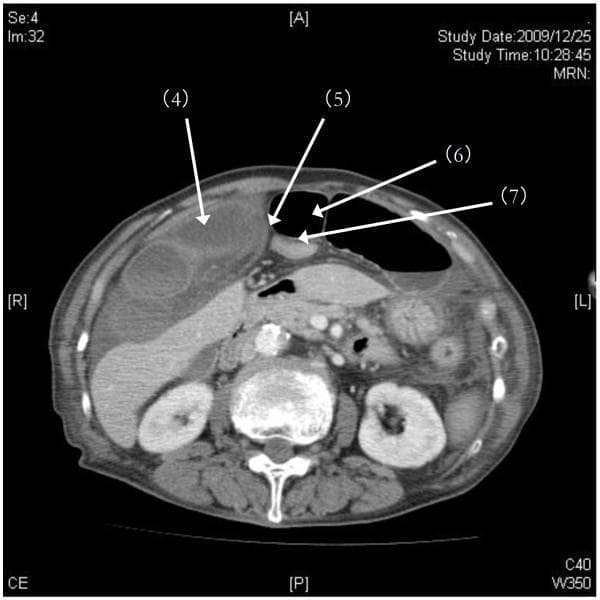 This diagnostic image is an axial (horizontal) helical computerized tomography (CT) scan of the upper abdomen, demonstrating signs of an internal hernia. The image reveals a closed loop of edematous intestine (labeled 4) positioned against the liver (segments S4 and S5). A key landmark, the falciform ligament (labeled 5), is visible as a linear membranous structure in the anterior-central abdomen. Pathological findings include significant air-filled dilation of the proximal intestines (labeled 6) on the left side of the abdomen, contrasted with the collapse of the distal intestine (labeled 7). These features are characteristic of a strangulated internal hernia through a defect in the falciform ligament, leading to mechanical bowel obstruction. The image highlights the distinctive visual differences between dilated, fluid-filled, and collapsed bowel loops in the context of emergent abdominal pathology. This clinical imaging is essential for students and residents studying surgical emergencies and radiologic interpretation of intestinal ischemia.
