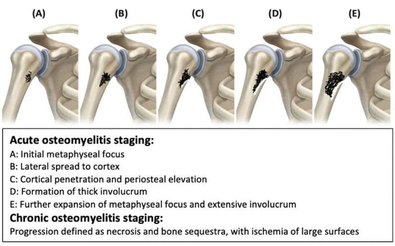 This medical illustration depicts the five-stage progression of osteomyelitis in the proximal humerus, categorized into acute and chronic phases. The series (A–E) visualizes the pathophysiology of bone infection: Stage A shows the initial metaphyseal focus of infection; Stage B demonstrates lateral spread toward the bone cortex; Stage C illustrates cortical penetration and subsequent periosteal elevation; Stage D identifies the formation of a thick involucrum (new bone growth surrounding infected tissue); and Stage E shows further expansion of the metaphyseal focus and extensive involucrum. The diagram highlights the anatomical relationship between the metaphysis, cortex, and periosteum during bacterial seeding and inflammatory response. Additionally, the content notes that chronic osteomyelitis is characterized by bone necrosis, formation of sequestra (detached dead bone), and large-surface ischemia. This anatomical diagram serves as an educational tool for medical students and clinicians to understand the radiological and pathological evolution of pediatric and adult bone infections.