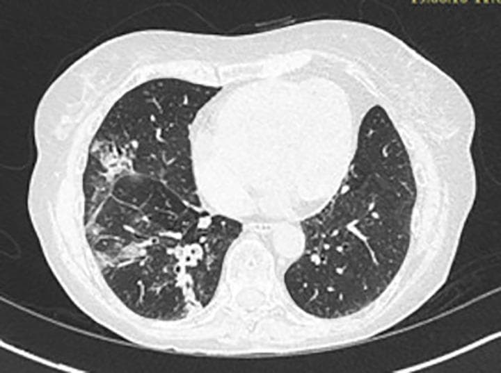 This diagnostic image is an axial chest CT scan showcasing a comparison of the bilateral lung parenchyma. In the right lung, there are prominent pathologic findings consisting of increased alveolar opacities and areas of consolidation located primarily in the medial and posterior basal segments. Within these regions of increased density, there are visible dilated and thick-walled bronchi, characteristic of bronchiectasis. The combination of these features creates a heterogeneous parenchymal texture on the right. In contrast, the left lung exhibits a relatively normal appearance with a homogeneous texture and preserved vascular markings. The scan highlights a localized pulmonary disease process, clinically relevant in the context of allergic bronchopulmonary aspergillosis (ABPA) or chronic infectious processes, where mucus plugging and bronchial dilation lead to segmental opacification and architectural changes.