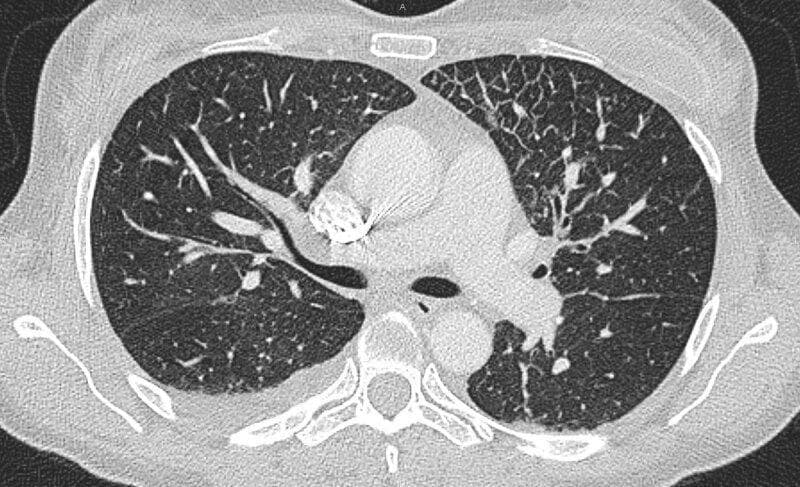 This diagnostic axial High-Resolution Computed Tomography (HRCT) image of the thorax demonstrates characteristic interstitial lung findings. The primary abnormality is diffuse, smooth interlobular septal thickening, which is most prominent in the anterior segment of the left lung's middle zone, creating a fine reticular pattern. No significant ground-glass opacities (GGO) are associated with this thickening at this level. Additionally, there is evidence of a small, localized pleural effusion along the posterior aspect of the left hemithorax. The mediastinal structures, including the heart and great vessels, are visible, though the primary educational focus remains on the parenchymal interstitial changes. Such patterns are clinically significant for various conditions, including pulmonary edema, lymphangitic carcinomatosis, or specific interstitial lung diseases. The image serves as an educational tool for identifying smooth septal thickening (Kerley lines on CT) and distinguishing secondary lobular anatomy in pulmonary radiology.