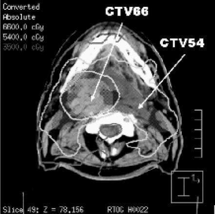 This diagnostic image is an axial computed tomography (CT) scan of the head and neck region, displaying an Intensity Modulated Radiation Therapy (IMRT) treatment plan. The image illustrates radiotherapy dose distribution through overlaid isodose lines and clinical target volumes (CTVs). The primary high-dose region, labeled CTV66, is an irregularly shaped area on the patient's right side, encompassed by the 6600.0 cGy (66 Gy) isodose line. A secondary target, labeled CTV54, represents a lower-dose volume situated lower in the neck, encompassed by the 5400.0 cGy (54 Gy) isodose line. A broader 3500.0 cGy (35 Gy) isodose line extends peripherally, demonstrating the dose fall-off toward surrounding healthy tissues. Key anatomical landmarks visible include the cervical vertebrae, mandible, and soft tissue structures of the neck. This image serves as an educational tool for understanding radiotherapy planning conformality, target volume delineation, and the spatial relationship between prescribed dose levels and cross-sectional anatomy in head and neck oncology.
