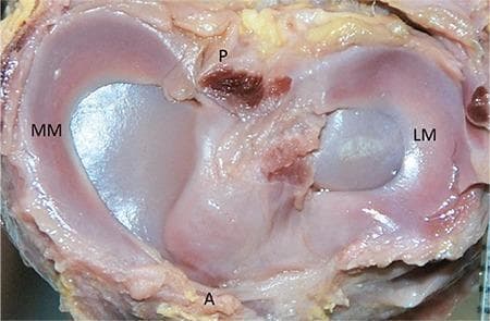 This clinical photograph shows a superior view of a dissected knee joint from a 32-week-old human fetus, illustrating the comparative morphology of the medial and lateral menisci. The medial meniscus (labeled MM) displays a classic sickle-shaped morphology, characterized by thin anterior and posterior horns and a relatively wider body with a substantial gap between the horns. In contrast, the lateral meniscus (labeled LM) exhibits a more circular 'C' shape. Anatomical landmarks including the anterior horn area (labeled A) and posterior horn area (labeled P) are visible, along with the tibial articular surfaces and associated soft tissue attachments. The image demonstrates key developmental anatomy and morphological classification of meniscal structures in the fetal period, highlighting the greater surface area often covered by the medial meniscus compared to the lateral. This visual is significant for orthopedic developmental studies and fetal anatomical education.