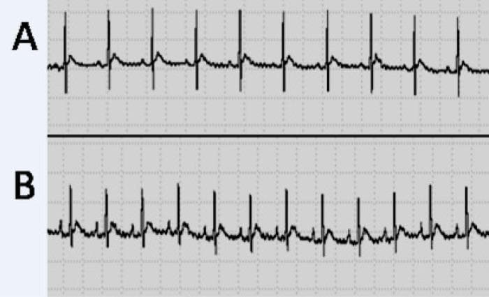 This diagnostic image shows two comparative electrocardiogram (ECG) rhythm strips, labeled A and B, displayed on a standard grid background. Both strips demonstrate a regular sinus rhythm with clearly identifiable P waves, QRS complexes, and T waves. Sample A represents a baseline or 'sham' control group, showing stable R-R intervals and standard waveform morphology. Sample B represents an experimental group (traumatic brain injury model) used to evaluate autonomic and cardiac effects. While the basic sinus rhythm remains intact, Sample B demonstrates subtle variations in the cardiac cycle, specifically in the P-wave duration and P-R interval as noted in related clinical studies. The ST segments in both samples appear isoelectric with no evidence of significant elevation or depression, and the T waves show normal upward deflection. This comparison is used in medical education to illustrate how systemic injuries, such as diffuse traumatic brain injury, can influence cardiac electrical activity and conduction intervals despite the absence of gross structural heart damage.