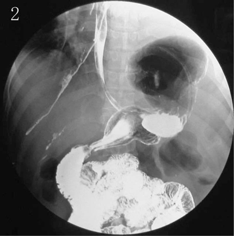 This diagnostic image is a contrast-enhanced fluoroscopic radiograph (barium or gastrografin swallow) of the upper alimentary tract. The study demonstrates a massive diaphragmatic hernia, characterized by the abnormal displacement of the stomach into the thoracic cavity. The esophagus is visible as a narrow, contrast-filled tube descending towards the herniated stomach, which appears as a large, globular, opacified structure located above the expected level of the diaphragm in the left hemithorax. An air-fluid level is visible within the stomach, indicating the presence of both gas and liquid contrast. Distal to the stomach, the pylorus and duodenum can be traced back through the diaphragmatic hiatus toward the abdominal cavity, where contrast-filled loops of small intestine (jejunum and ileum) are visible with their characteristic mucosal patterns. This image illustrates a severe disruption of normal thoracoabdominal anatomy, typical of a large hiatal or traumatic diaphragmatic hernia requiring surgical intervention.