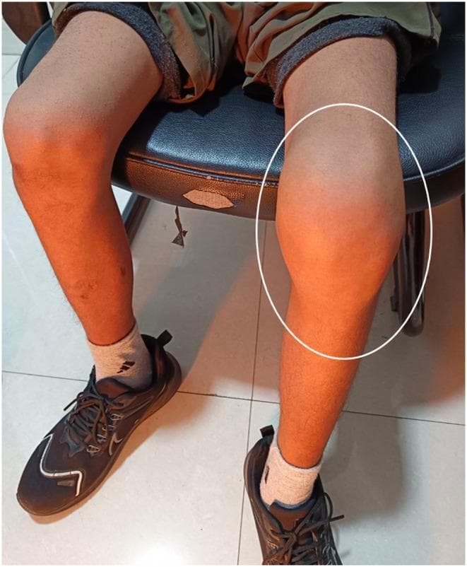 This clinical photograph displays a comparative view of the lower limbs in a seated patient, focusing on the knee joints. The primary finding is significant, diffuse swelling of the left knee (highlighted with a white circle) compared to the anatomically normal right knee. The swelling is localized around the patellar region, extending into the suprapatellar and infrapatellar areas, resulting in the loss of normal bony landmarks and joint contours. The skin overlying the affected joint appears intact without obvious erythema, bruising, or open lesions, though it appears tense due to underlying mass effect or effusion. This presentation is characteristic of hemophilic arthropathy or pseudotumor in a patient with a bleeding disorder like hemophilia A. The image serves as an educational tool for identifying joint effusion and musculoskeletal manifestations of systemic hematologic conditions. Key anatomical landmarks include the distal femur, proximal tibia, and patella, all obscured by the localized enlargement.