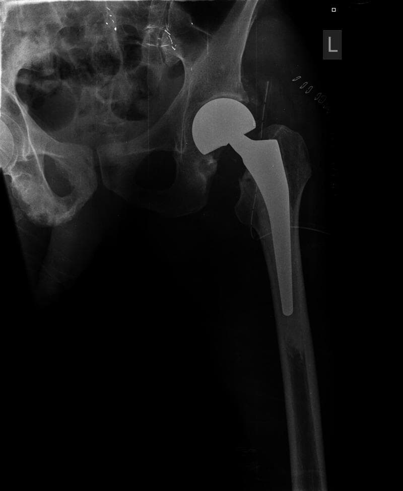 This diagnostic image is an anteroposterior (AP) radiograph of the left hip demonstrating a post-surgical cemented bipolar hemiarthroplasty. The orthopedic implant consists of a radio-opaque femoral stem well-seated within the intramedullary canal of the proximal femur, and a large-diameter bipolar femoral head articulating with the native acetabulum. There is evidence of bone cement appearing as a radiodense interface between the stem and the femoral cortex. Visible surgical markers include small, radio-opaque hemostatic clips in the periacetabular soft tissues and linear radiopaque sutures or markers along the lateral aspect of the hip joint. The radiograph confirms appropriate postoperative alignment of the prosthetic components relative to the pelvic and femoral anatomy. This visual serves as an educational example of hip arthroplasty for femoral neck fractures, highlighting implant positioning and common postoperative radiographic findings in orthopedic surgery.