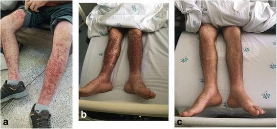 This series of clinical photographs (panels a, b, and c) documents the temporal progression and resolution of leukocytoclastic vasculitis manifesting as palpable purpura on the lower limbs of a patient following chemotherapy. Panel 'a' shows the initial presentation with discrete, erythematous to violaceous macules and papules concentrated on the shins and calves. Panel 'b' demonstrates the peak intensity of the condition, where the lesions have become confluent, forming dense, dark-purple purpuric plaques covering a significant surface area of the bilaterally affected legs. Panel 'c' captures the resolution phase, showing a marked decrease in the number and intensity of lesions, with the skin returning to near-normal pigmentation, though residual faint hyperpigmentation persists. The images illustrate a classic dermatological drug reaction or systemic response, characterized by the symmetrical distribution of purpuric lesions in gravity-dependent areas, typical of small-vessel vasculitis.
