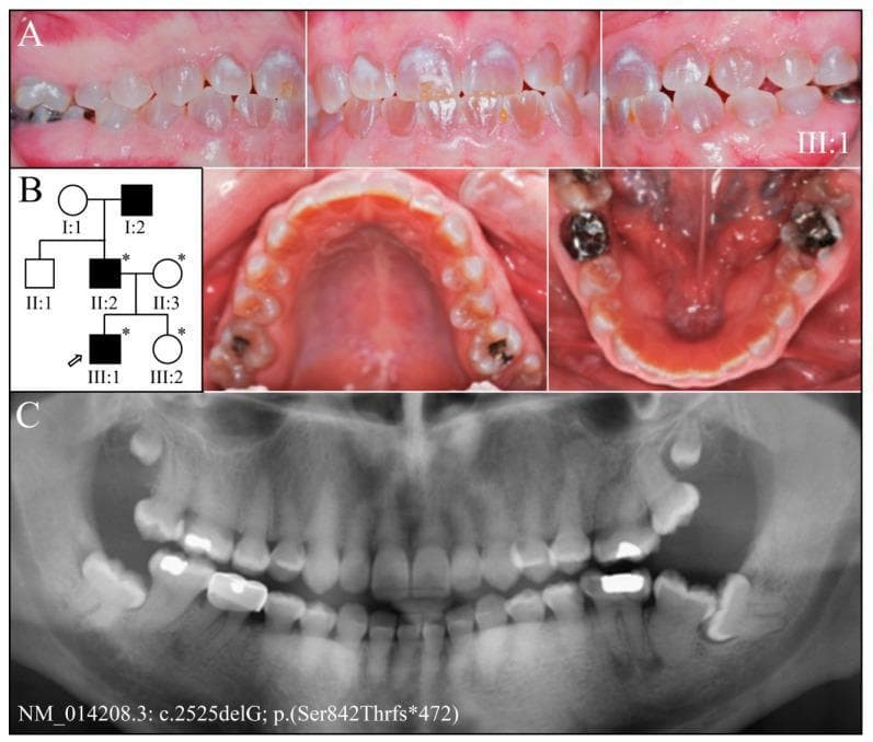 Educational composite image illustrating the clinical and radiographic features of Dentinogenesis Imperfecta Type II (DGI-II). Panel A presents multiple intraoral clinical photographs of a 19-year-old patient (proband III:1), showing a permanent dentition with characteristic amber-brown opalescent discoloration. There is evidence of enamel chipping on the buccal surfaces of the maxillary central incisors, while overall occlusal attrition appears mild and the wear facets remain smooth. Panel B shows a three-generation pedigree indicating an autosomal dominant inheritance pattern of the condition within the family. Panel C displays a panoramic radiograph (panorex) revealing significant internal dental anomalies: generalized obliteration of pulp chambers and root canals, bulbous posterior crowns with cervical constriction, and abnormally short roots on the anterior teeth. Radiographically, the enamel thickness appears within normal limits despite the underlying dentin defect. Several radiopaque dental restorations (crowns) are visible. This visual summary correlates clinical dental phenotypes with radiographic findings and genetic lineage in hereditary dentin disorders.