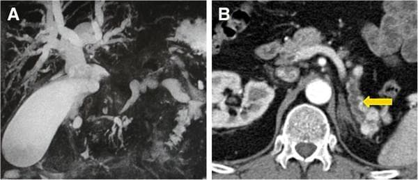 This composite diagnostic image illustrates secondary complications of pancreatic pathology, specifically ductal obstruction. Panel A is a Magnetic Resonance Cholangiopancreatography (MRCP) showing a significant dilatation of the intrahepatic and extrahepatic biliary tree. There is a marked expansion of the common bile duct and gallbladder, secondary to a distal obstruction. The branching bile ducts appear thickened and tortuous, indicating high-pressure upstream effects. Panel B is an axial contrast-enhanced CT scan of the abdomen showing a dilated main pancreatic duct, indicated by a yellow arrow. The pancreatic duct exhibits distal dilatation with a beaded or irregular morphology, a finding commonly associated with proximal mass lesions or chronic obstructive changes. Together, these images demonstrate 'double duct sign' characteristics, where both biliary and pancreatic drainage systems are compromised, frequently seen in periampullary or pancreatic head tumors such as metastases or primary carcinoma.