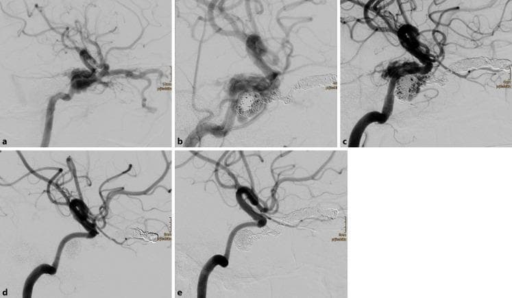 This series of digital subtraction angiograms (DSA) illustrates the endovascular management and longitudinal progression of a traumatic direct carotid-cavernous sinus fistula (CCSF). Image (a) demonstrates the baseline pathology: a massive arteriovenous shunt from the cavernous segment of the right internal carotid artery (ICA) into the adjacent cavernous sinus. Image (b) shows the initial intervention, featuring densely packed detachable coils within the superior ophthalmic vein and cavernous sinus, combined with the deployment of flow diverters within the ICA. Image (c) shows a follow-up DSA 6 days later, identifying a residual shunt that necessitated the placement of additional flow diverters to increase the construct's metal coverage and further promote thrombosis. Images (d) and (e) represent long-term follow-up at 2 and 8 months, respectively, showing complete occlusion of the fistula, absence of venous shunting, and restoration of normal arterial flow. The series highlights a combined endovascular approach using both coil embolization and flow-diverting stents to achieve definitive occlusion of high-flow traumatic arteriovenous communications.